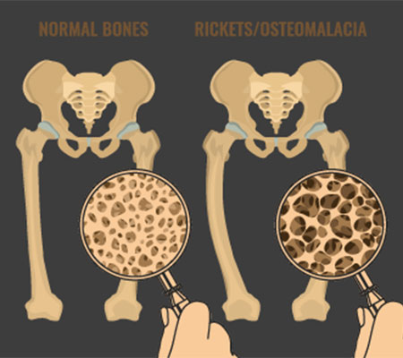 Rickets – A preventable skeletal disorder