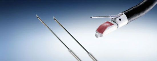 Lung cancer diagnosis has gone from major surgery to day procedure thanks to medical ingenuity